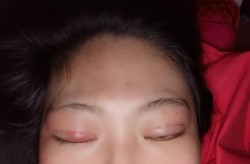 韩式三点双眼皮手术的优势是什么？有没有风险？
