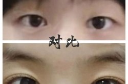 单眼皮变双眼皮手术方法有哪些？哪种最自然？