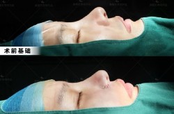 鼻翼收缩手术效果好吗？鼻翼整形需要注意什么？