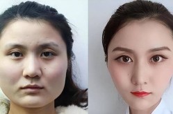 削骨手术后遗症有哪些？如何避免？