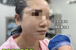 鼻唇沟微整形手术风险大吗？