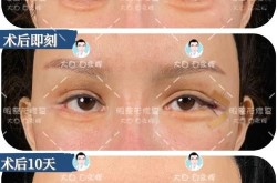 外眼角手术可以让眼睛变大吗？风险高吗？