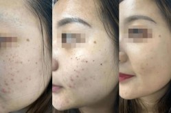 dpl激光美容效果如何？与传统激光有何区别？