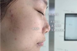 鼻翼塑形手术怎么做？效果自然吗？