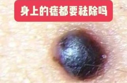 黑色素痣需要治疗吗？有哪些治疗方法？
