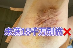 腋臭手术价格贵吗？手术和药物治疗哪个更彻底？