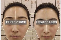 做改脸型术需要多少钱？手术风险与效果分析