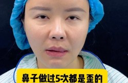 歪鼻子整形手术风险大吗？效果自然吗？