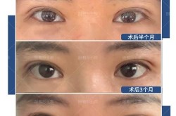 双眼皮成型术哪种自然？价格和恢复期是多久？