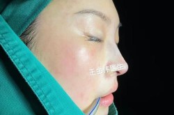 韩式鼻部整形手术特点是什么？效果好吗？