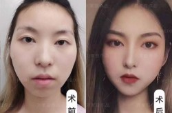 隆太阳穴手术风险大吗？有哪些术后注意事项？