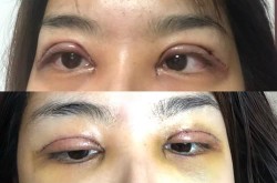 切开双眼皮过程是怎样的？痛不痛？