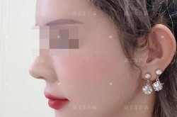 整容磨骨手术有哪些风险？需要注意什么？