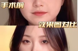 溶脂技术哪种最安全有效？适合所有人吗？