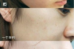 激光去斑一般多少钱？效果能维持多久？