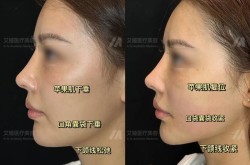 双蛋合体是什么？在整形美容中有哪些应用？