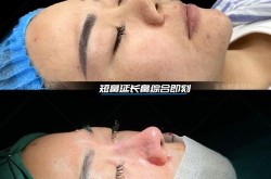 酒糟鼻整形术风险大吗？术后如何护理？