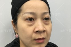 外切眼袋手术风险大吗？术后恢复期多久？