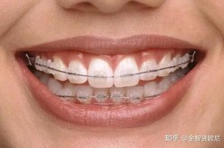 正畸手术费用贵不贵？一般要戴多久的牙套？