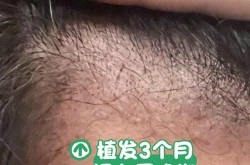 植发手术需要多少钱？植发手术的恢复期和效果如何？