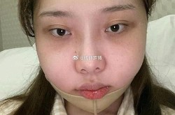 下颌角磨骨术恢复期要多久？有没有风险？