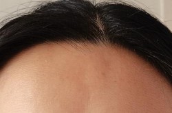 额头窄丰额头手术多少钱？术后护理难吗？