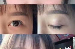 埋线双眼皮收费是多少？恢复期多久？
