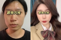 颧骨内推手术的价格是多少？术后如何护理？