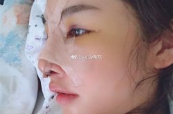 隆鼻手术疼不疼？恢复期需要多久？