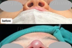 鼻尖整形整容后注意事项有哪些？怎样护理？