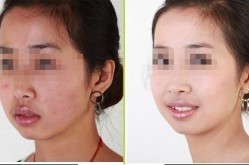 黑脸娃娃是什么美容项目？效果真的好吗？