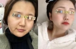 面部吸脂术后恢复期多久？效果能维持多久？