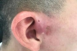 耳前瘘管手术风险大不大？术后需要多久恢复？