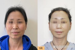 抬头纹手术价格是多少？效果明显吗？
