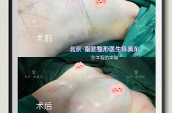 自体脂肪丰胸手术有哪些优点？适合哪些人？