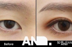 单眼皮如何变双眼皮？手术和非手术方法哪种好？