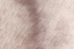 疤痕疙瘩治疗有没有快速有效的方法？求指导！