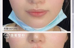 唇部丰唇手术怎么做？恢复期需要多久？
