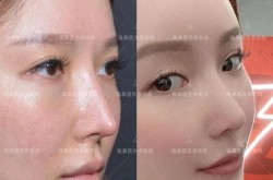 畸形鼻部整形手术复杂吗？术后效果怎么样？