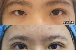 面部下垂整形的价格是多少？手术效果持久吗？