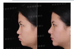 垫鼻子手术疼吗？恢复期需要注意些什么？