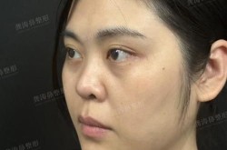 鼻翼整形术的价格和术后恢复是怎样的？