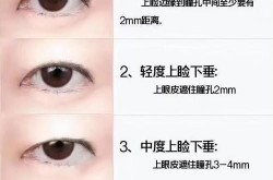 开外眼角手术多少钱？术后需要注意什么？