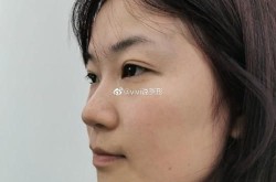 做双眼皮的医院那么多，如何挑选？