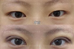 石家庄双眼皮手术哪里做得好？有哪些手术方式？