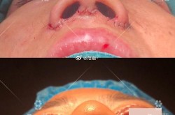 鼻梁增高手术安全吗？效果可以维持多久？
