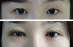 眼睛整形手术价格贵不贵？有风险吗？
