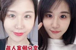 上海植发医院哪个好？求真实案例分享！