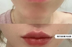 玻尿酸丰唇整形效果好吗？有哪些注意事项？