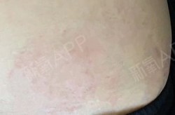 丹凤朝阳医院整形科怎么样？真实案例分享！